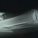 BrokenLeg1