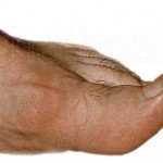 gout-foot